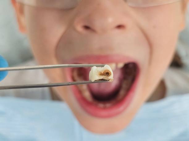 Best Emergency Tooth Extraction in Park Ridge, IL